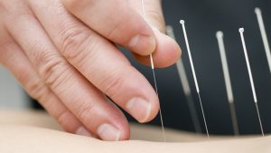 Dry needling